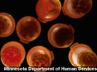 New painkiller designed to discourage abuse