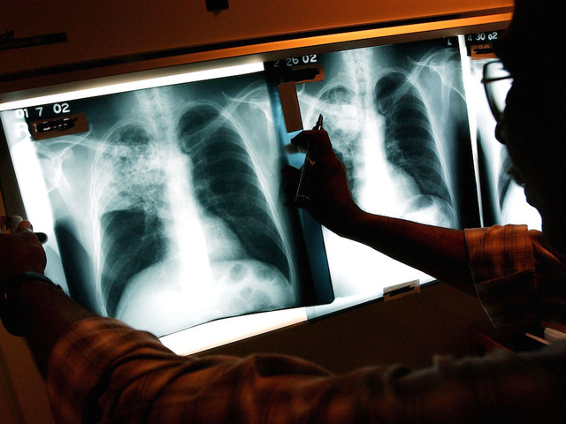 Case of tuberculosis confirmed at metro Detroit elementary school