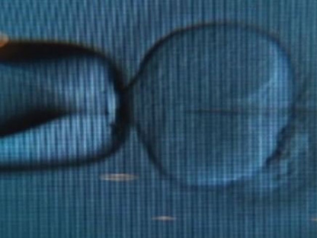 Legal actions grow after loss of frozen embryos